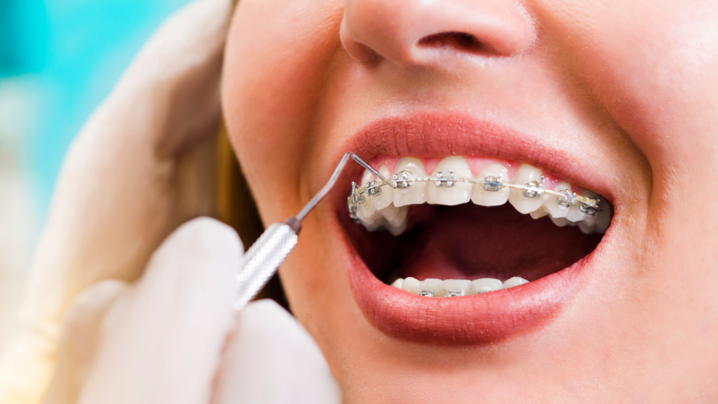 orthodontie-bagues-metallique-ceramique-evry